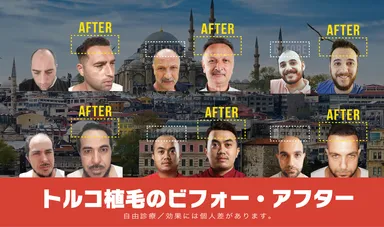 トルコ植毛のビフォーアフター