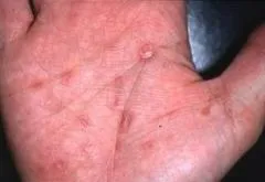 梅毒 第2期の発疹(1)