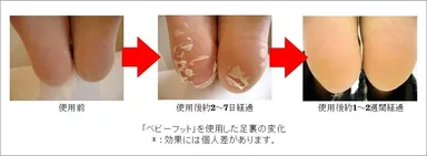 ベビーフットを使用した足裏の変化