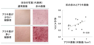肌の赤みとアクネ菌数との関係