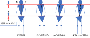 図3 側弯傾向の種別