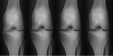 (図1)幹細胞施術前後の関節のレントゲン
