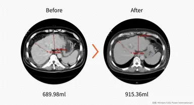 (図2)肝硬変(59歳, 男性)-施術後