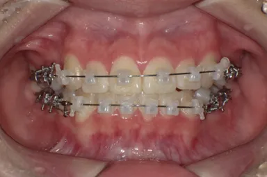 日本人に最適化した歯列矯正治療法「JET system」により、 7か月で治療