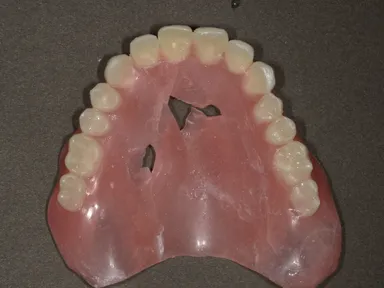 日常で多い入れ歯の破損