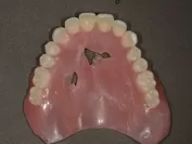 日常で多い入れ歯の破損