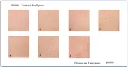図1　毛穴グレードの評価基準※　※Kim, S. J., et al. "Pore volume is most highly correlated with the visual assessment of skin pores. " Skin Research and Technology 20.4 (2014): 429-434.