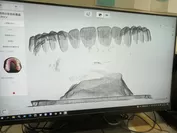 入れ歯の形状をスキャン中(2)