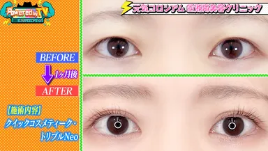 埋没法二重術 施術例