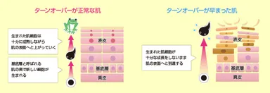 ターンオーバーの異常