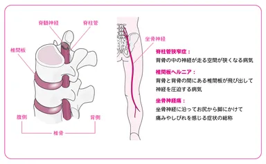 痛みやしびれを伴う代表的な疾患