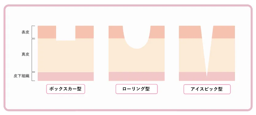 凹みの種類