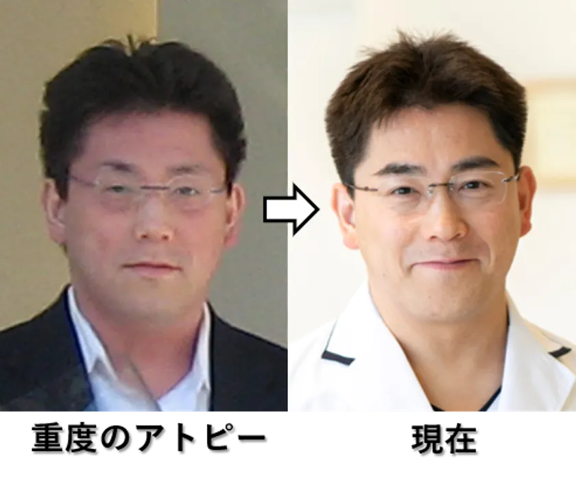 図4:重度のアトピーの時と現在の院長の写真