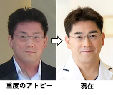 図4：重度のアトピーの時と現在の院長の写真