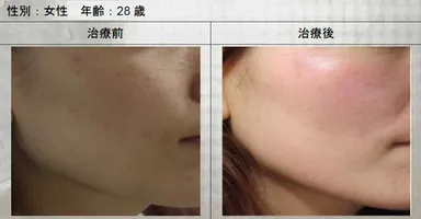美白症例写真