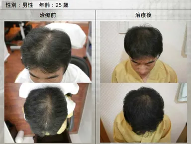 薄毛症例写真