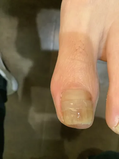 目立たない矯正器具