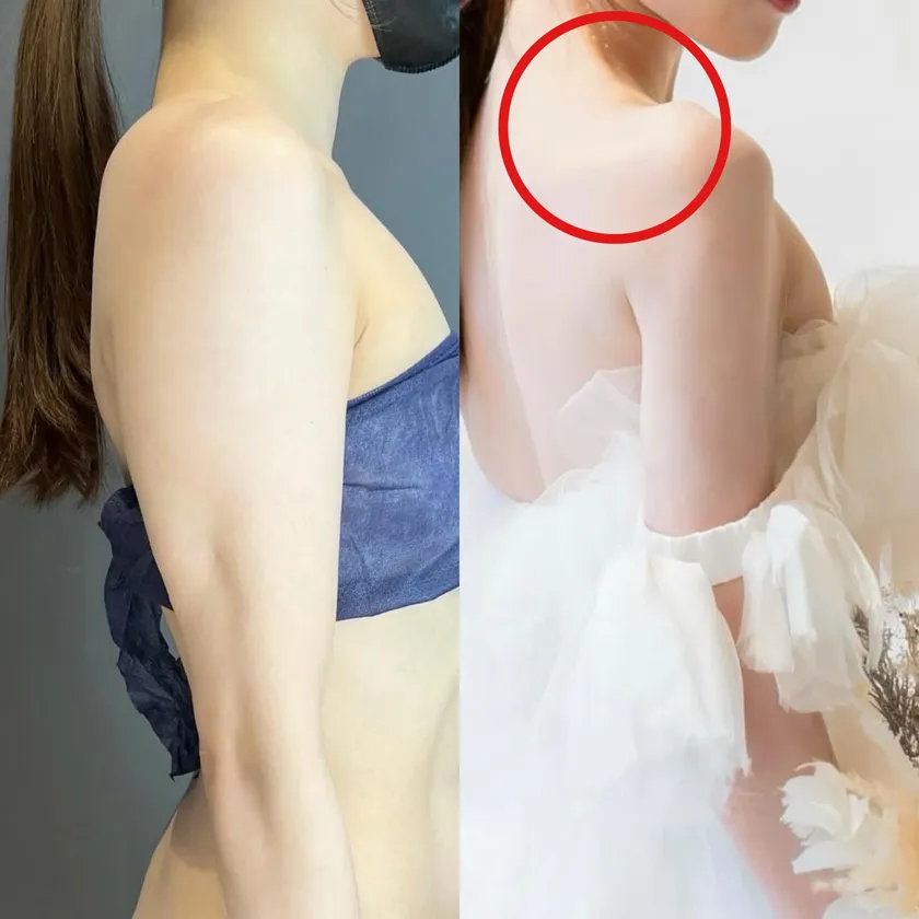 肩周りをスッキリさせたい全ての方へ