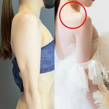 肩周りをスッキリさせたい全ての方へ