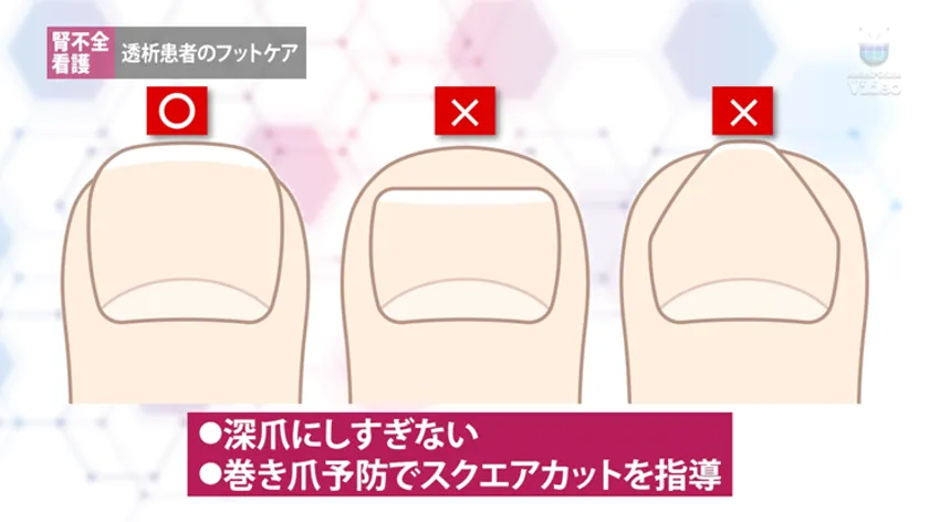 透析患者のフットケア