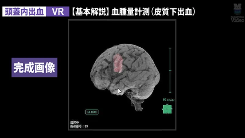 頭蓋内出血(血腫量計測)
