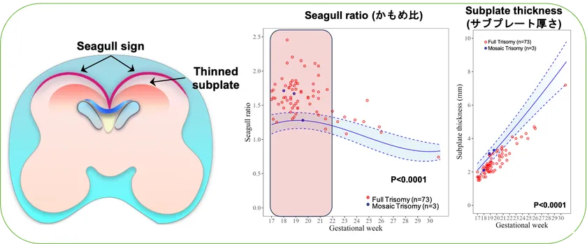ダウン症の脳ではかもめが羽を広げた様な脳表面の形(かもめサイン、Seagull sign)と脳の薄いサブプレート(Thinned subplate)が特徴的です(左図)。ダウン症のある胎児では、かもめ比とサブプレート厚さの傾向は類似していますが、一人ひとり違う値を示しています。