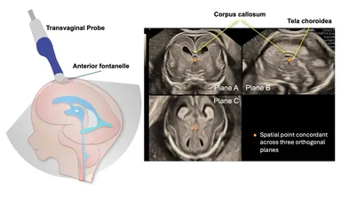 20年以上にわたる夫 律子医師の詳細な経腟3D胎児脳超音波検査の積み重ね
