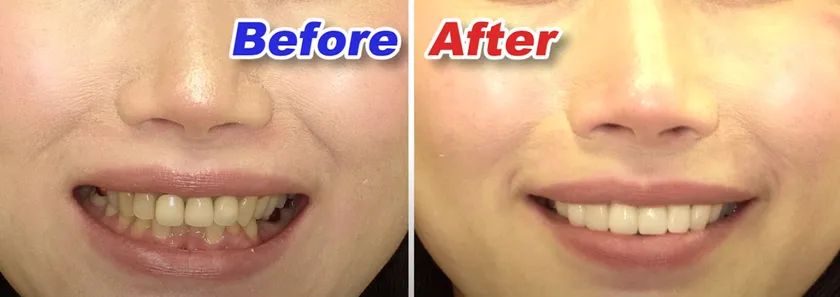 美しい歯と最高の笑顔を手に入れた小河麻理子さんのルミネアーズ治療