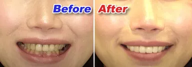 美しい歯と最高の笑顔を手に入れた小河麻理子さんのルミネアーズ治療