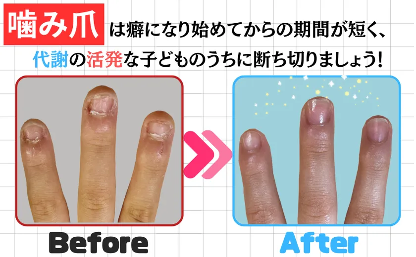 バイバイ!噛み爪_Before&After