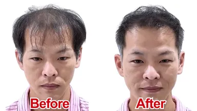 U字薄毛をカットで改善(1)