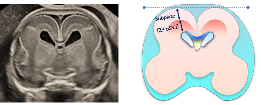 胎児脳サブプレート研究