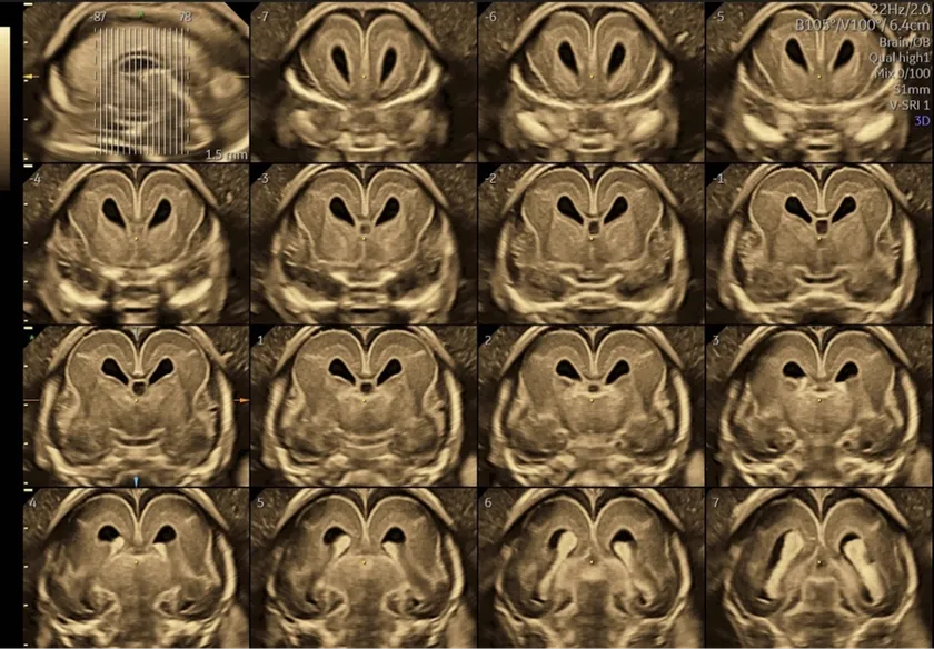 胎児脳の診断はここまで精密な画像で行わなければならないと夫医師は話す