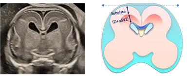 胎児脳サブプレート研究