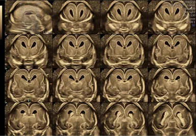 胎児脳の診断はここまで精密な画像で行わなければならないと夫医師は話す