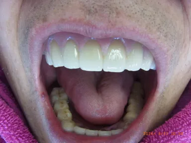 大きく開けても落ちません