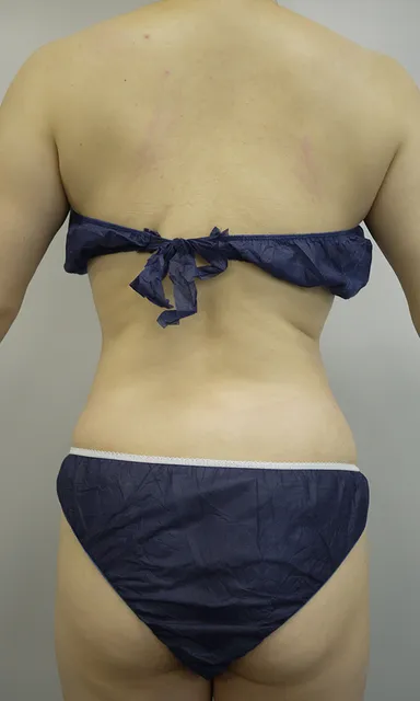 モンスター塗布28日間＋筋膜リリース2回