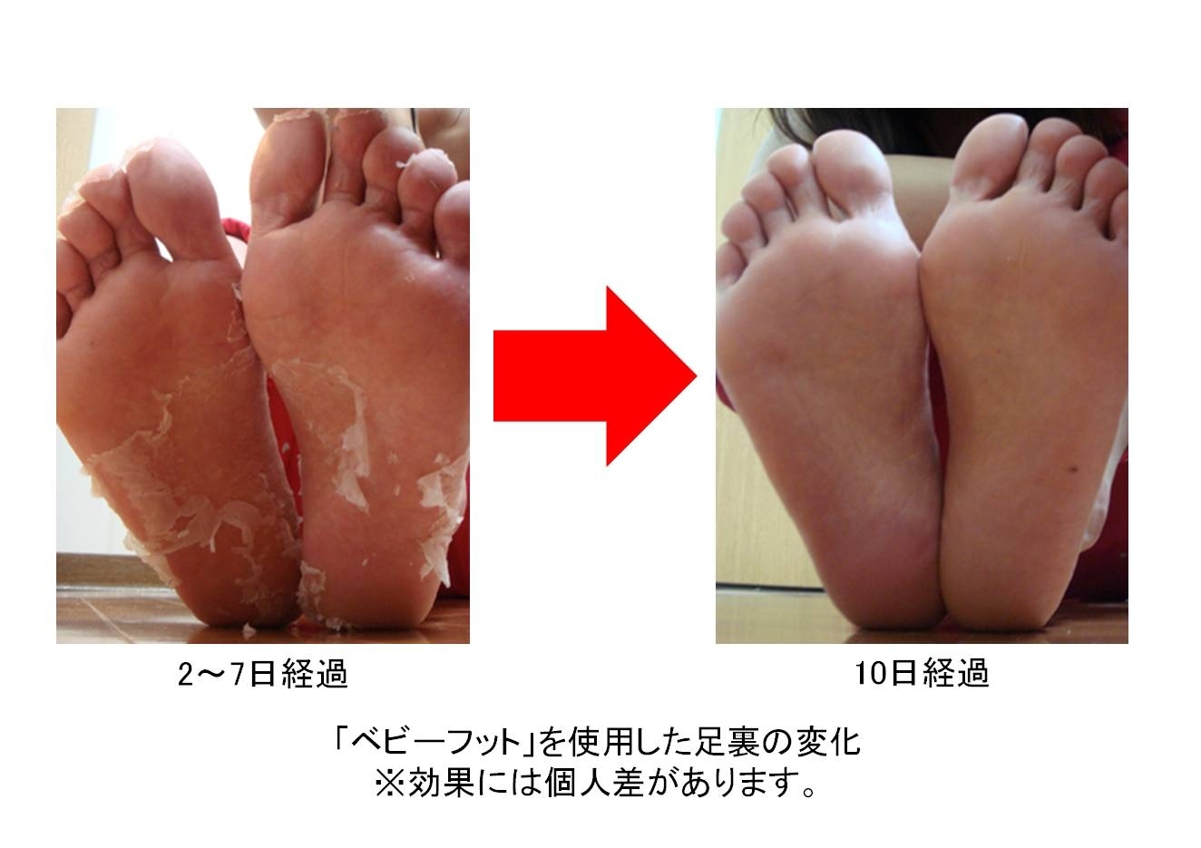 衝撃の足裏画像で話題のコンテスト 足裏ズルむけ Beautyコンテスト14春 今年一の足裏は誰だ ノミネート作品を発表 株式会社リベルタのプレスリリース 衝撃の足裏画像で話題のコンテスト 足裏ズルむけ Beautyコンテスト14春 今年一の足裏は誰だ ノミネート作品を発表 株式会社リベルタのプレスリリース