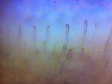 毛細血管の血流観察を無料で実施