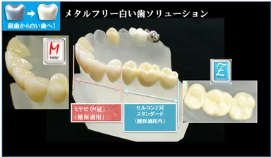 図4：メタルフリー、白い歯ソリューション