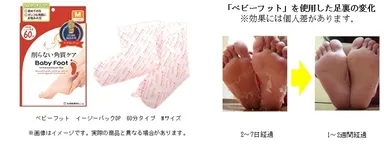 「ベビーフット」を使用した足裏の変化