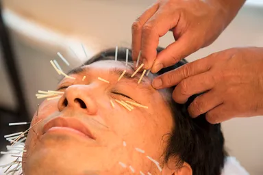 顔の鍼施術