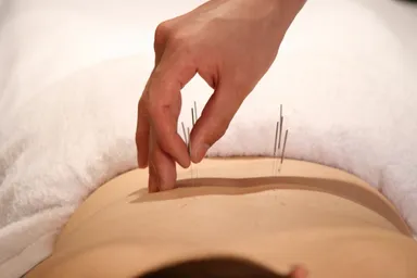 身体の鍼施術(背面)