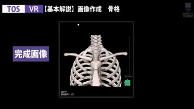 3D画像製作 胸郭出口症候群