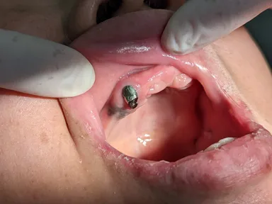 片顎だけ総入れ歯の人も多い