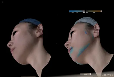 ボリューム変化解析