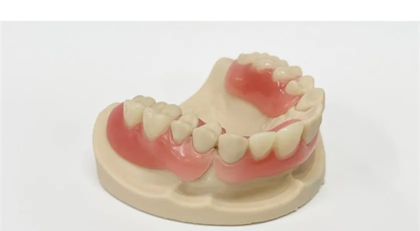 デジタルで作成した三和デンタルのパーシャルデンチャー(部分入れ歯)である「スマイルLivion」の実物