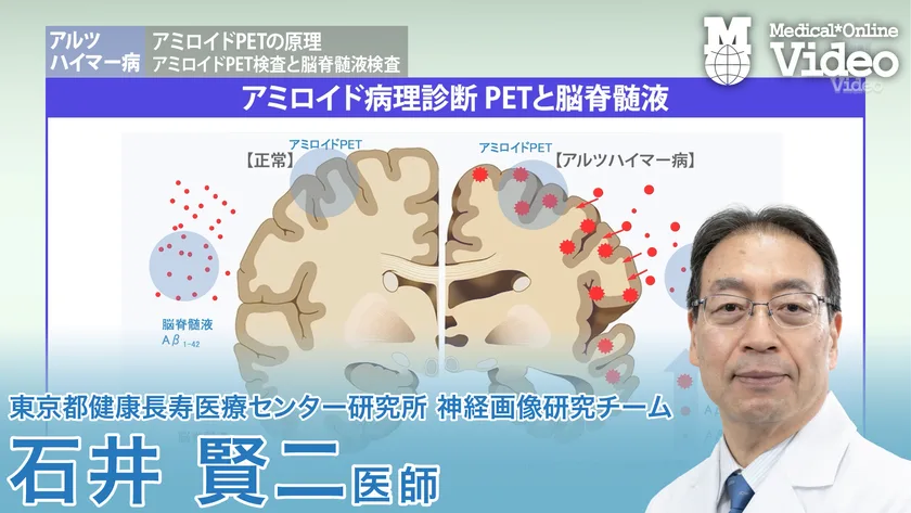 アルツハイマー病 アミロイドPETの原理 ガイドライン概要