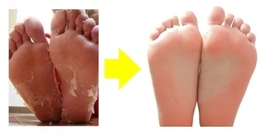 ベビーフット使用中→使用後