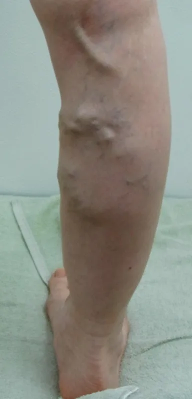 下肢静脈瘤